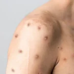 Lesões na pele causadas pela Mpox, doença viral cujos sintomas podem durar de 2 a 4 semanas.