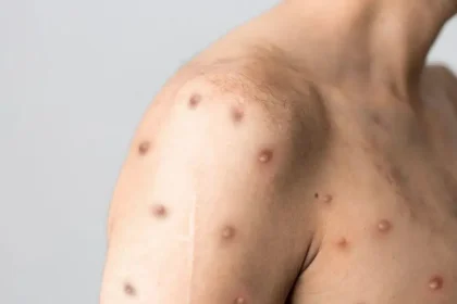 Lesões na pele causadas pela Mpox, doença viral cujos sintomas podem durar de 2 a 4 semanas.